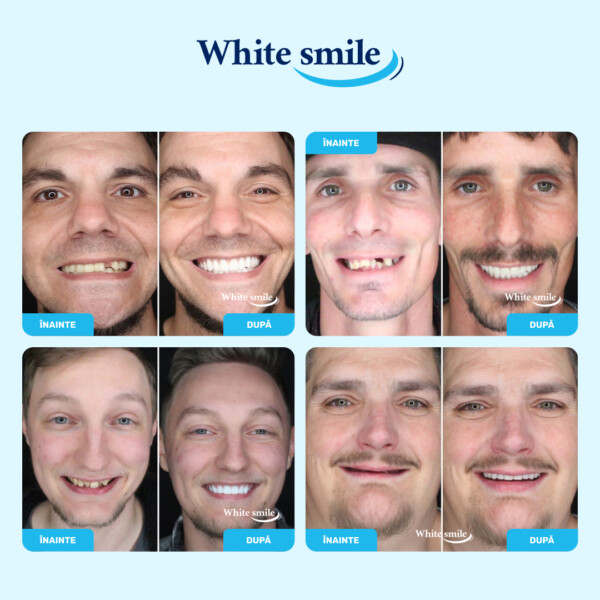 Dinți falși cu aspect realist: WhiteSmile - imagine 3